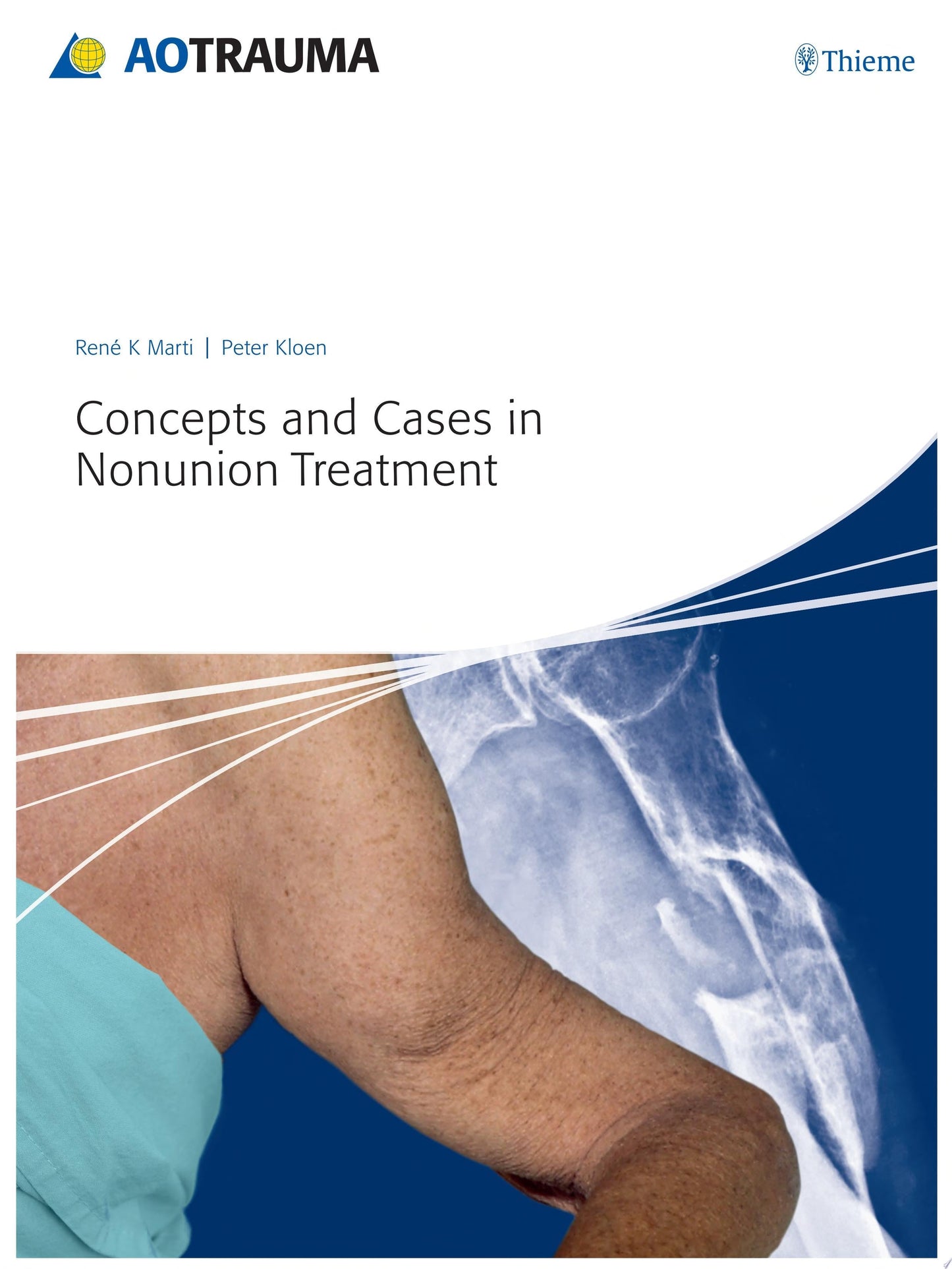 Concepts and Cases in Nonunion Treatment